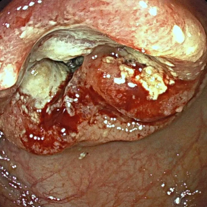 Cancer du côlon : tumeur bourgeonnante, ulcérée et saignante, rétrécissant la lumière intestinale.