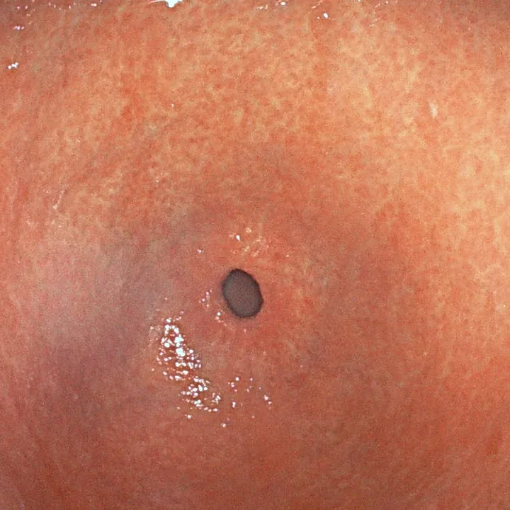 Gastrite : muqueuse de l'antre rouge et inflammatoire, en amont du pylore.