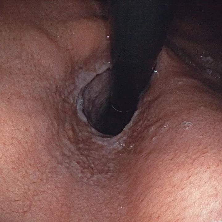 Vue endoscopique en rétrovision : l'endoscope, retourné dans l'estomac, observe le cardia par en dessous.