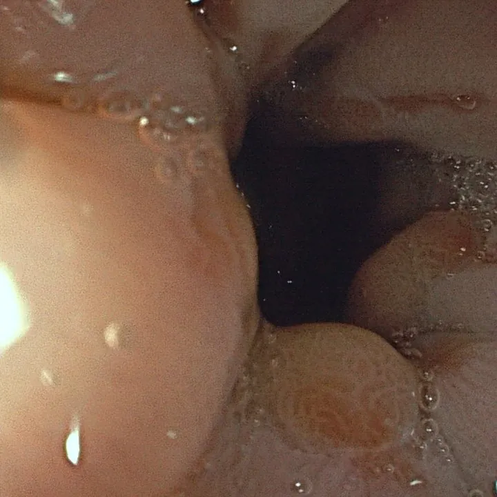 Œsophagite vue en endoscopie.
